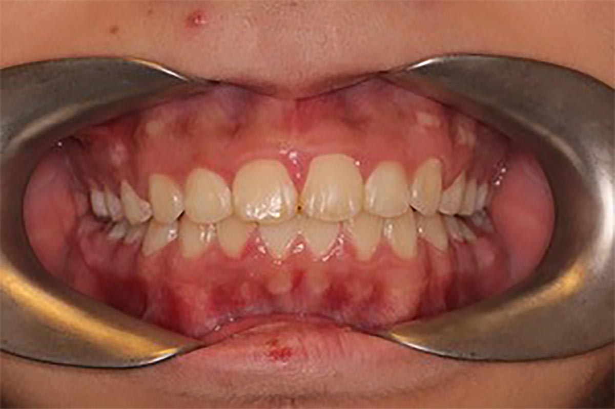 Priory Dentist - orthodontist - braces - treatments - before and after