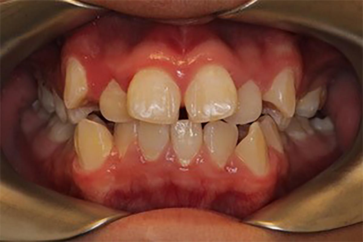 Priory Dentist - orthodontist - braces - treatments - before and after
